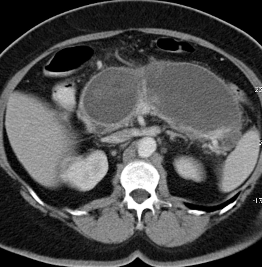 Walled Off Pancreatic Necrosis